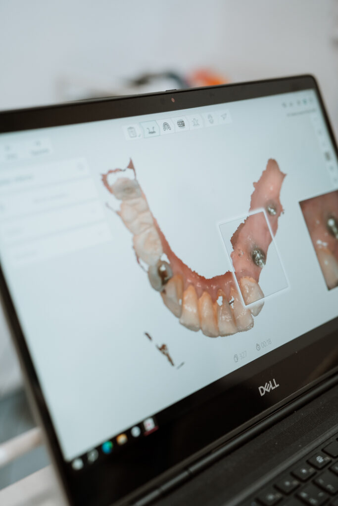 Implantes Dentales Aluche